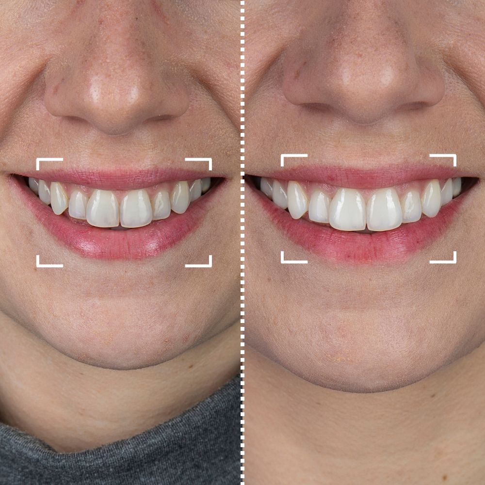 Before & After