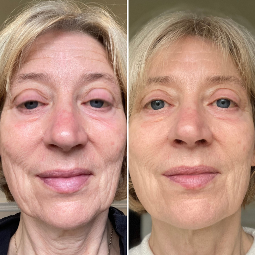 Before & After